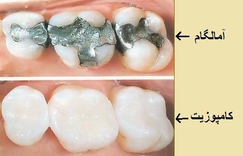 ماده آمالگام دندان و دستگاه آمالگاماتور