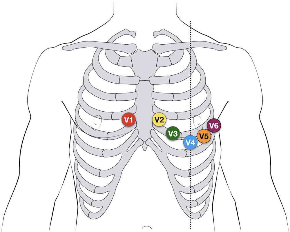 نحوه اتصال الکترود های سینه ای نوار قلب ecg 